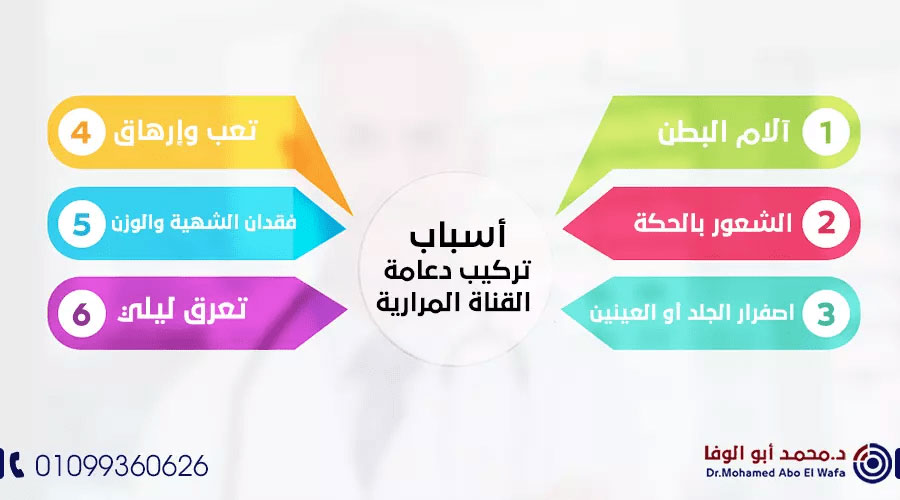 تركيب-دعامة-القناة-المرارية