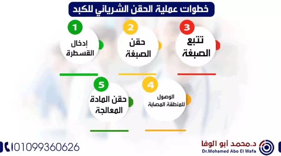 حقن-شرياني-للكبد