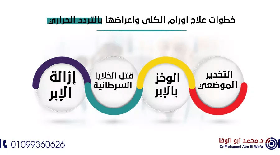 علاج-اورام-الكلى-بالاشعة-التداخلية-والتردد-الحراري