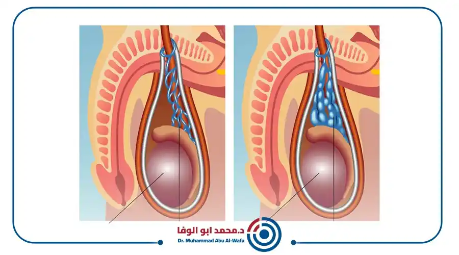علاج دوالي الخصية بالحقن بدون جراحة