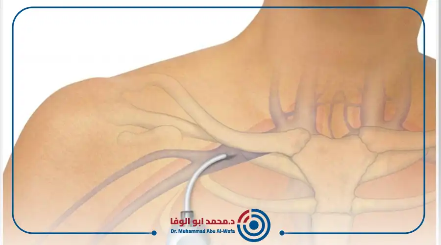 علاج الاورام بالاشعة التداخلية وجهاز البورتكاث