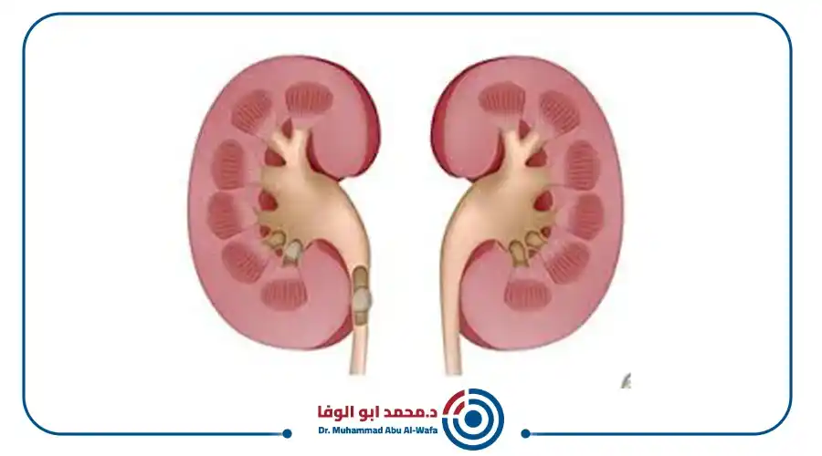 تضيق الشريان الكلوي وعلاجه بالأشعة التداخلية (توسيع الشرايين بالبالون)