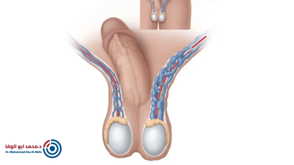 علاج دوالى الخصية بدون جراحة