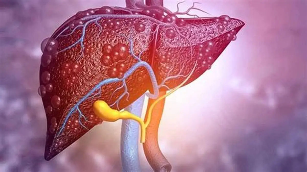 علاج أورام الكبد
