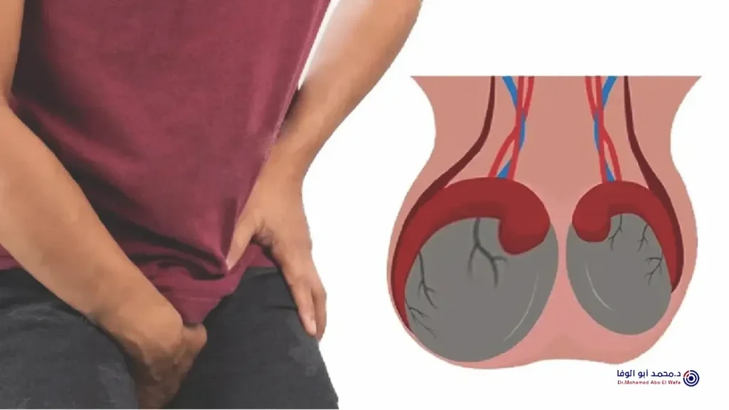 افضل علاج لدوالي الخصية