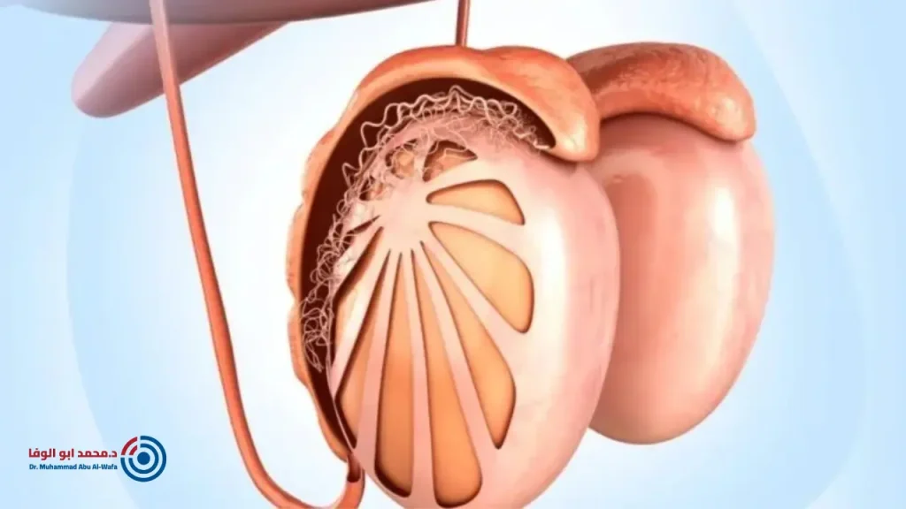 دوالي الخصية اليسرى