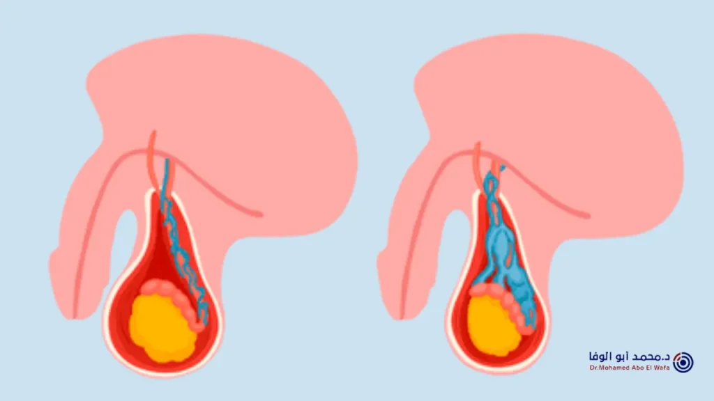دوالي الخصية اليمنى