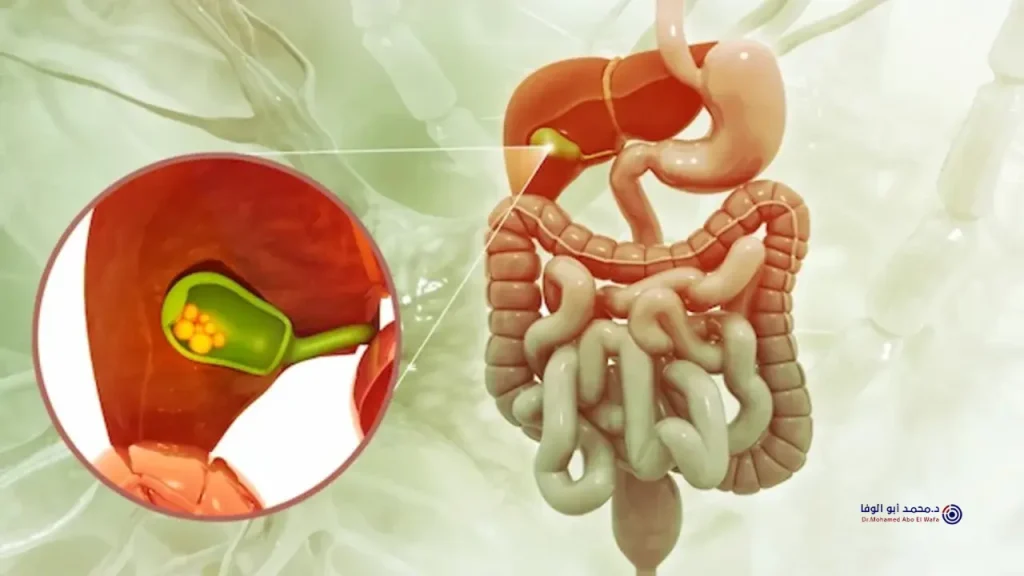 إزالة الحصوات من القناة الصفراوية بالمنظار بدون جراحة